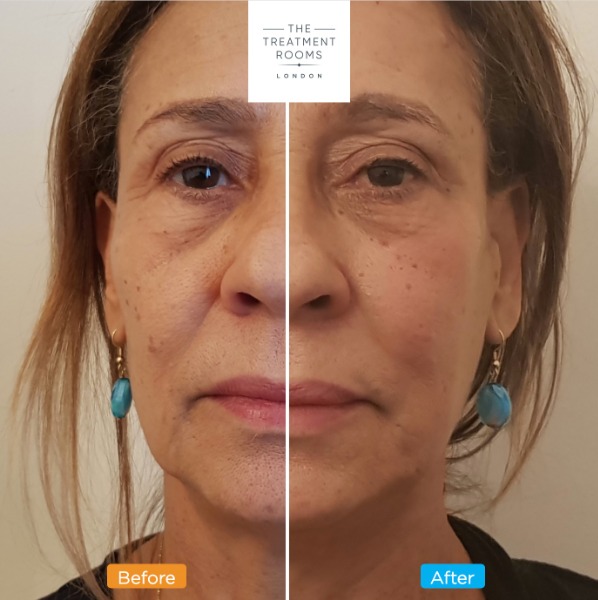 Mid Cheek Filler